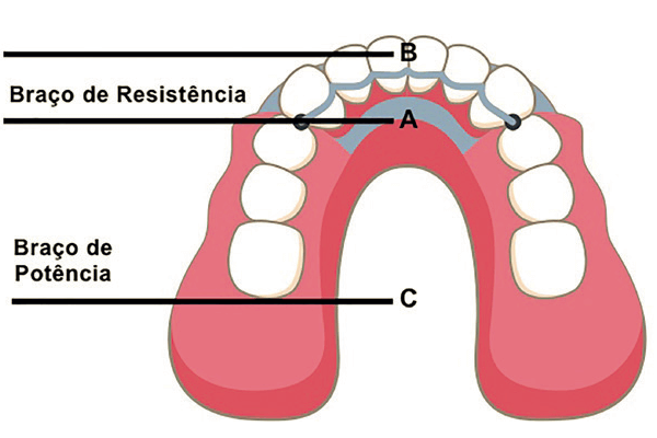 Read more about the article Como funcionam as alavancas em próteses dentárias: uma revisão de conceitos biomecânicos