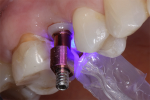 novo conceito de implantes