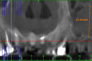 Read more about the article Prevalência e relevância de patologias de seio maxilar – uma análise retrospectiva em tomografias computadorizadas de feixe cônico