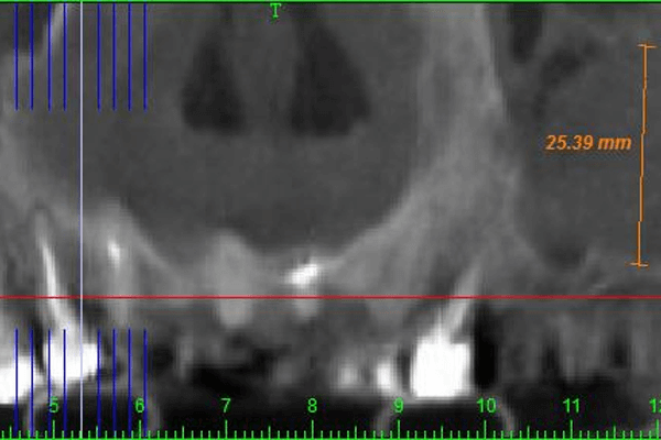 Read more about the article Prevalência e relevância de patologias de seio maxilar – uma análise retrospectiva em tomografias computadorizadas de feixe cônico