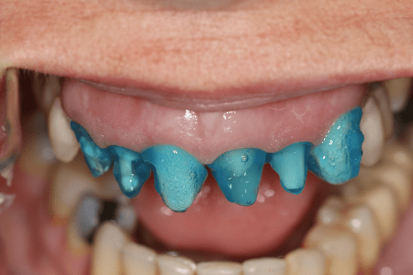 Read more about the article Equalizando a cor através de restaurações totais e parciais em leucita sobre dentes e implantes