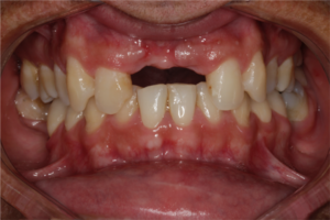 Read more about the article Implantes dentários estreitos em reabilitação de área estética anterior