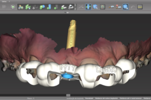 Read more about the article DinatoDigital oferece solução para cirurgia guiada para cirurgiões-dentistas