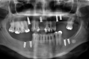 Periodontia e Implantodontia