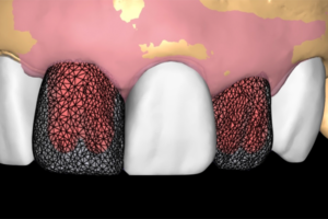 Read more about the article Previsibilidade e replicabilidade em restaurações digitais sobre implantes