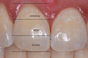 Read more about the article Análise do fenótipo gengival: equivalência entre métodos visual e clínico – estudo transversal