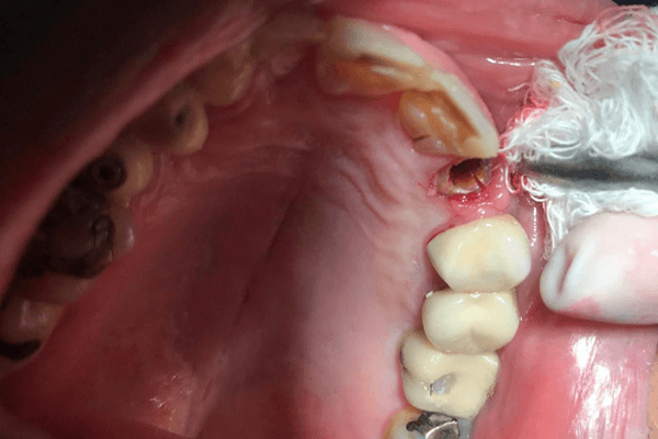 Read more about the article Fraturas radiculares em dentes com núcleos metálicos fundidos