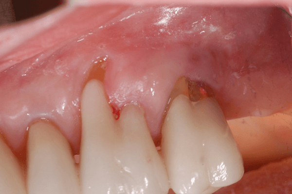 Read more about the article A rizectomia como alternativa para o tratamento de lesões endo-periodontais