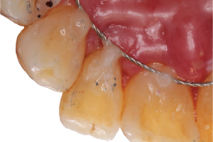 Read more about the article Regeneração periodontal em defeitos intraósseos – fatores a considerar previamente à cirurgia
