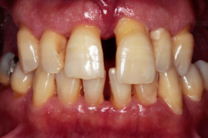 Read more about the article Tratamento multidisciplinar de periodontite crônica severa