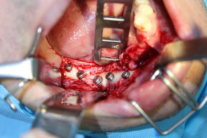 Read more about the article Reconstrução mandibular imediata com enxerto livre de fíbula associada à reabilitação oral com implantes dentários em dois tempos cirúrgicos – follow-up de 16 anos