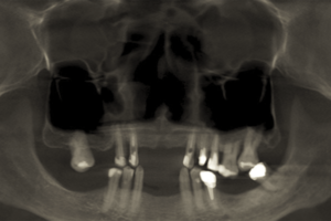 periodontite Covid-19
