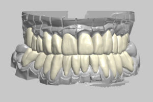 Read more about the article Reabilitação total em zircônia monolítica CAD/CAM