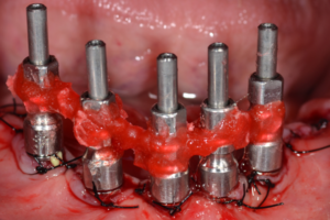 Read more about the article Reabilitação oral com implantes dentários em carga imediata no paciente com transplante de fígado – relato de caso com um ano de acompanhamento