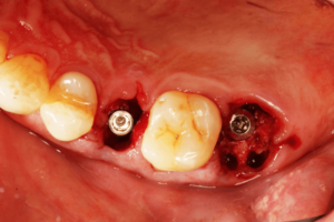 Read more about the article Implante imediato em sítio infectado