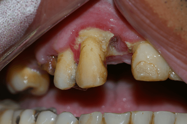 doenças periodontais necrosantes HIV
