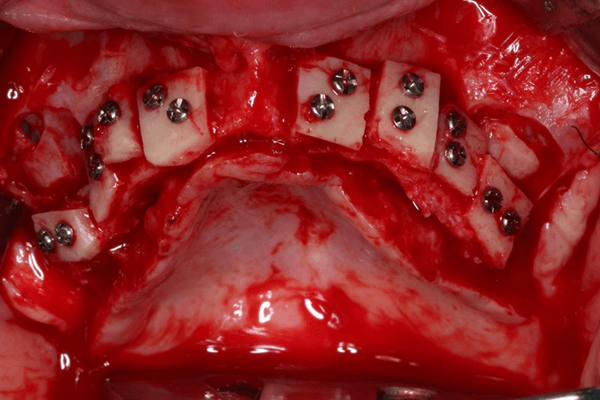 Read more about the article Reconstrução de maxila atrófica com enxerto de calvária para reabilitação com implantes