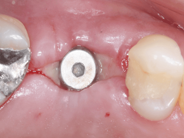Read more about the article O efeito da osseodensificação na Implantodontia