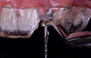Read more about the article Guias cirúrgicos de precisão em Implantodontia