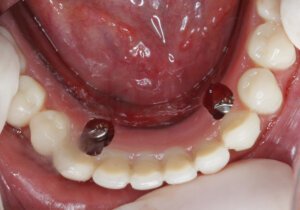 Read more about the article Overdentures mandibulares
