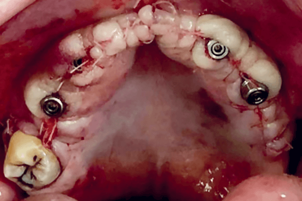 Read more about the article Implantes transnasais: técnica Vanderlim como alternativa à técnica Zygoma Quad em maxilas totais atróficas – série de 12 casos em carga imediata e acompanhamento de dois a 26 meses