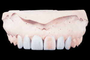 Read more about the article Reabilitação estética-funcional com abordagem híbrida em dentes anteriores