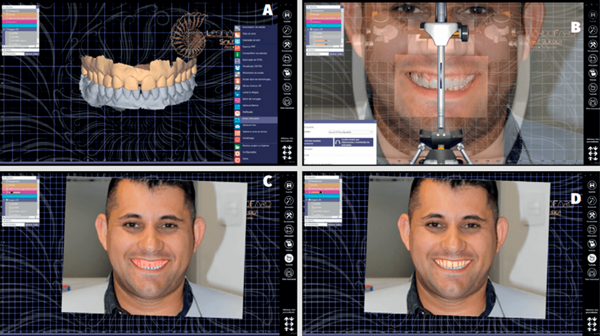 Planejamento digital 3D e facetas laminadas em CAD/CAM - ImplantNews