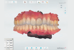 Read more about the article Implantodontia e Ortodontia estética e digital integradas por softwares