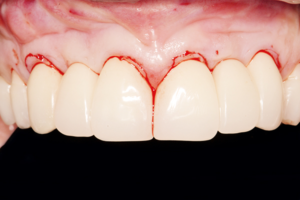 Cirurgia plástica periodontal