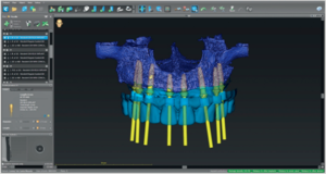 Read more about the article Vantagens das estruturas fresadas (CAD/CAM) sobre as estruturas fundidas