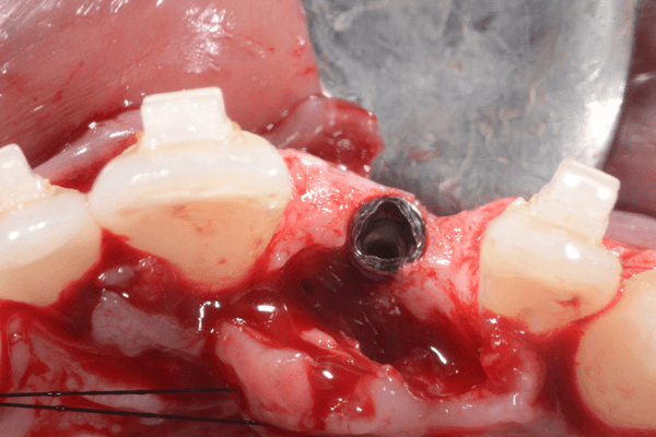 Read more about the article Expansão óssea com instrumentos rotatórios para instalação de implante na região estética com 15 meses de acompanhamento