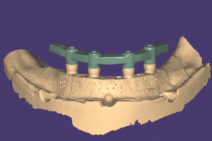 Read more about the article Avaliação do desajuste horizontal em infraestruturas para próteses totais implantossuportadas obtidas com o uso de moldagem digital e convencional