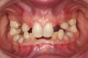 Read more about the article Tratamento multidisciplinar da oligodontia não sindrômica