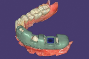 Read more about the article Erro responsável: o impacto da cirurgia guiada na Implantodontia com ferramentas digitais