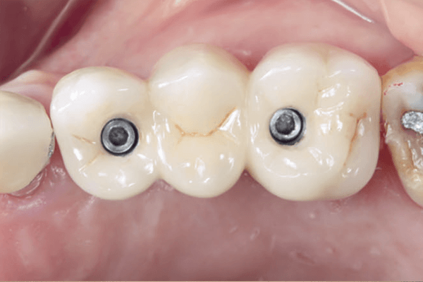 Mandíbula e Maxila c/ Fossa Articular, Implantes, Próteses e Procotolo com  4 Implantes