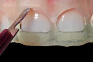 cirurgias plásticas periodontais
