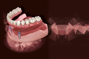Read more about the article Overdentures: qual é o patamar atual?