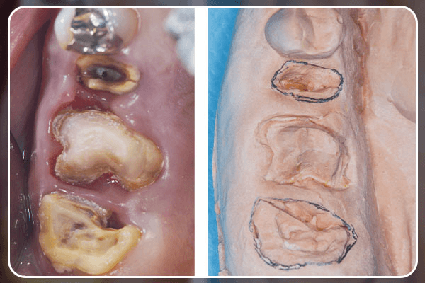 Read more about the article RAPG simultânea em dois alvéolos posteriores da maxila