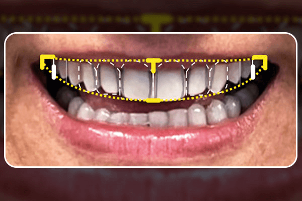 Read more about the article Planejamento digital dos sorrisos em prótese dentária
