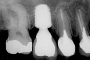 Read more about the article Implantes curtos na reabilitação implantossuportada