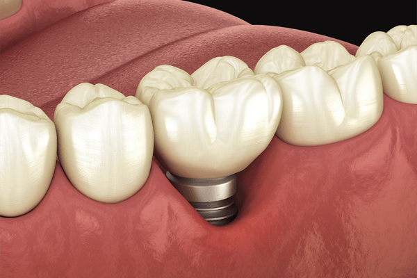 You are currently viewing Recessão gengival ao redor de implantes dentários: substitutos mucosos
