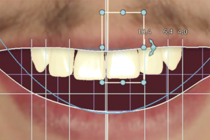 Read more about the article Fluxo digital em reabilitação estética por meio de laminados cerâmicos