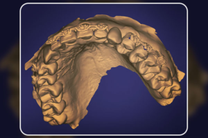 Read more about the article Fluxo digital completo no planejamento de implantes e coroas provisórias