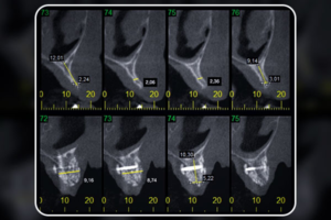 Read more about the article Barbell Technique: reconstrução óssea efetiva em Implantodontia
