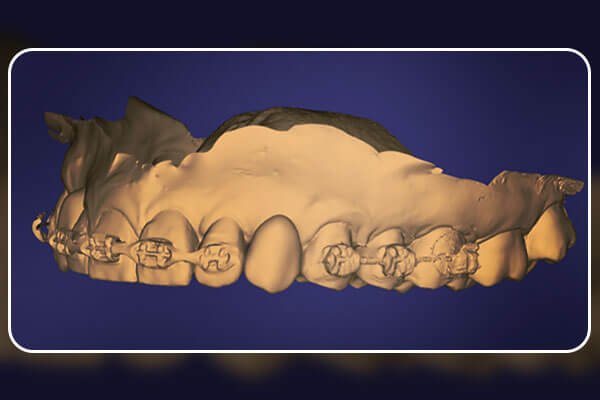 Fluxo digital completo no planejamento de implantes e coroas provisórias Revista ImplantNews