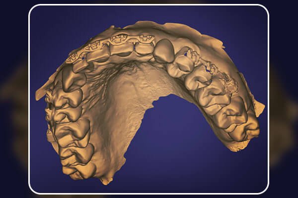 Fluxo Digital Completo No Planejamento De Implantes E Coroas Provis Rias Revista Implantnews