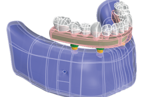 Read more about the article Determinação do comportamento biomecânico de um novo componente para próteses múltiplas parafusadas