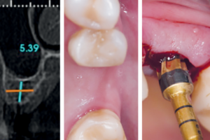 Read more about the article Os benefícios da osseodensificação na Implantodontia atual