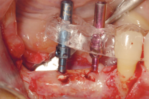 Read more about the article Regeneração óssea guiada vertical e horizontal em região posterior de mandíbula para reabilitação implantossuportada. Relato de caso com 44 meses de acompanhamento