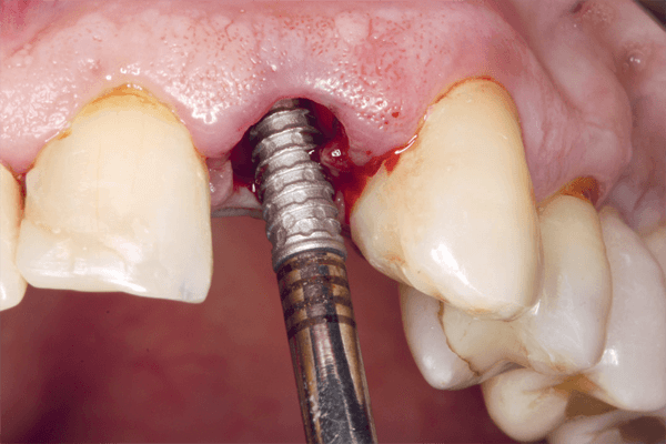 Read more about the article Implante dentário com estética imediata – relato de caso